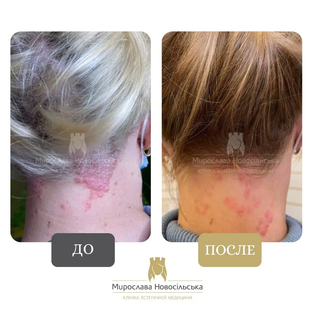 Лазерное лечение псориаза, фото 12