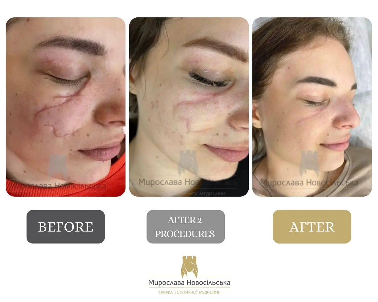 Laser scar removal, photo 11