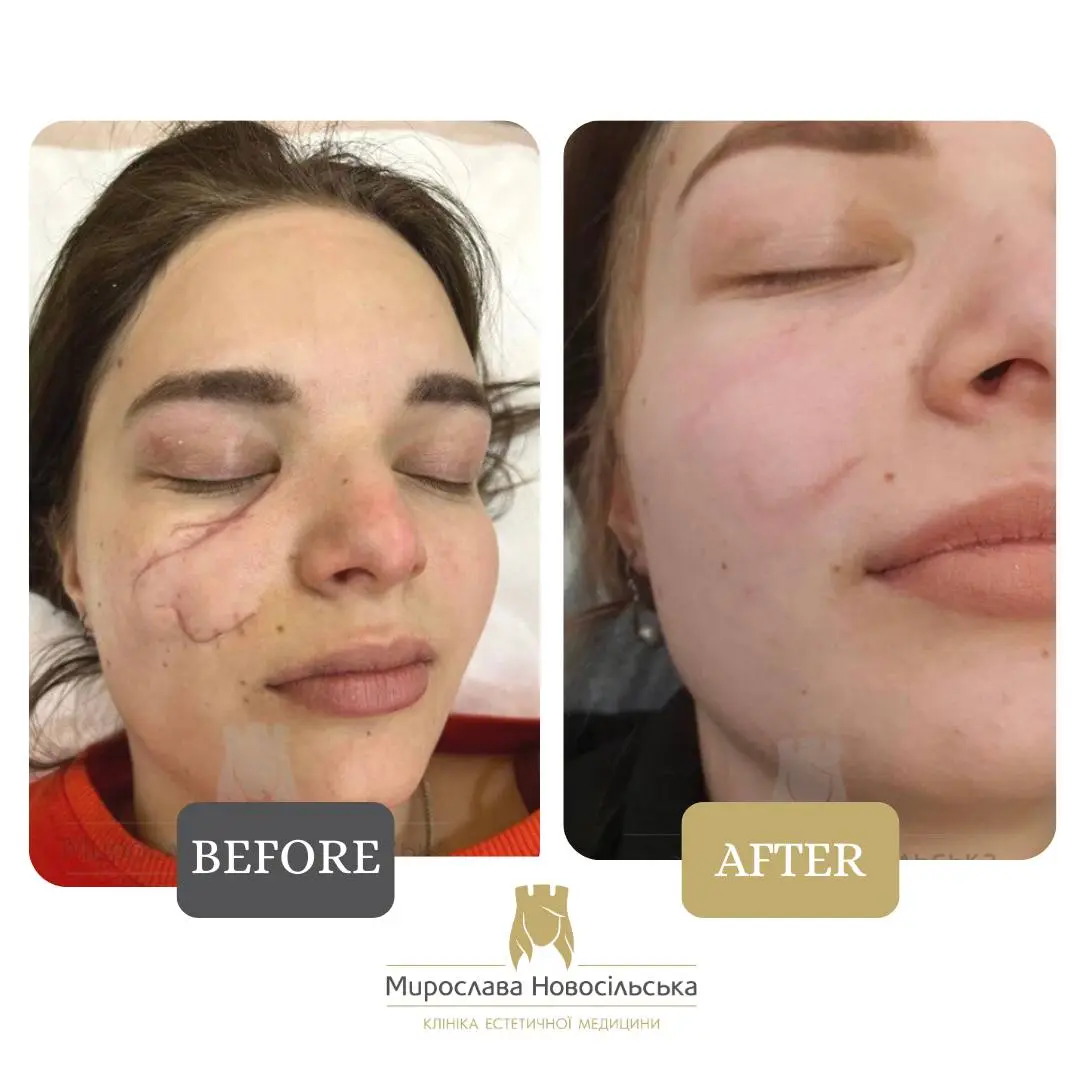 Laser scar removal, photo 2