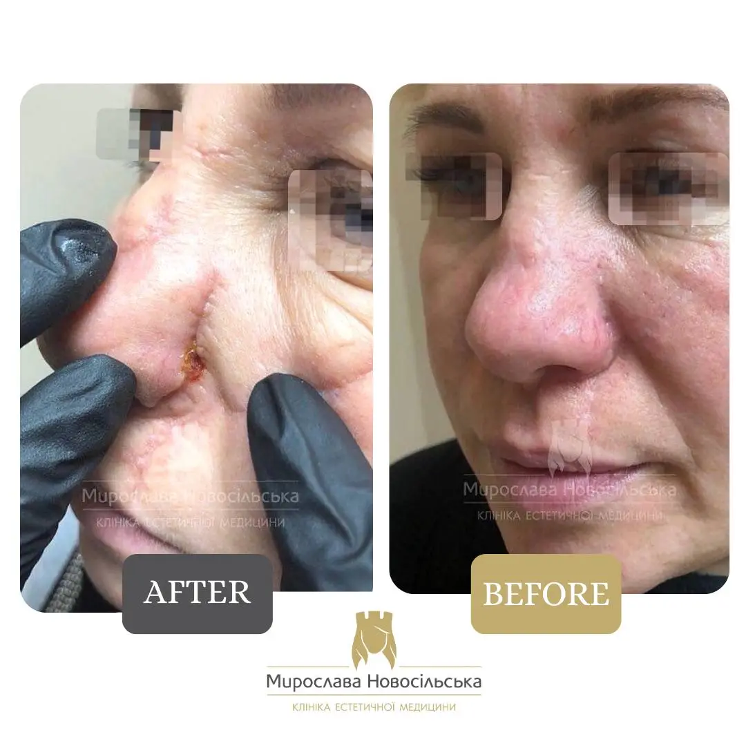 Laser scar removal, photo 12