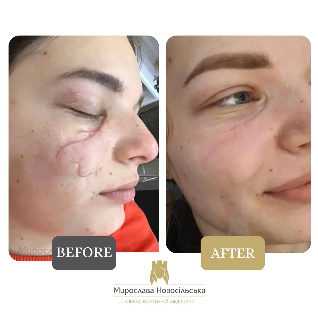 Laser scar removal, photo 13