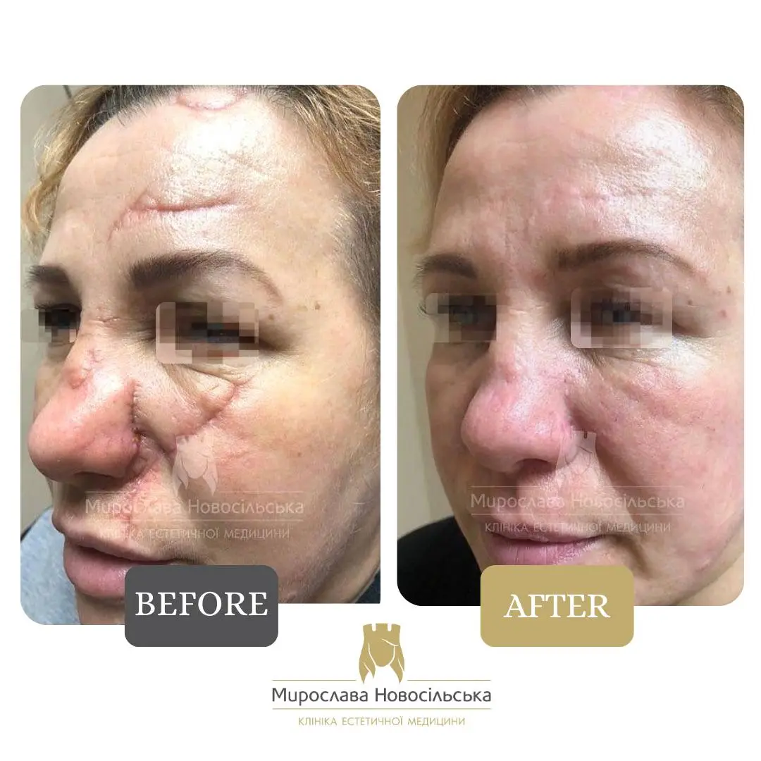 Laser scar removal, photo 14