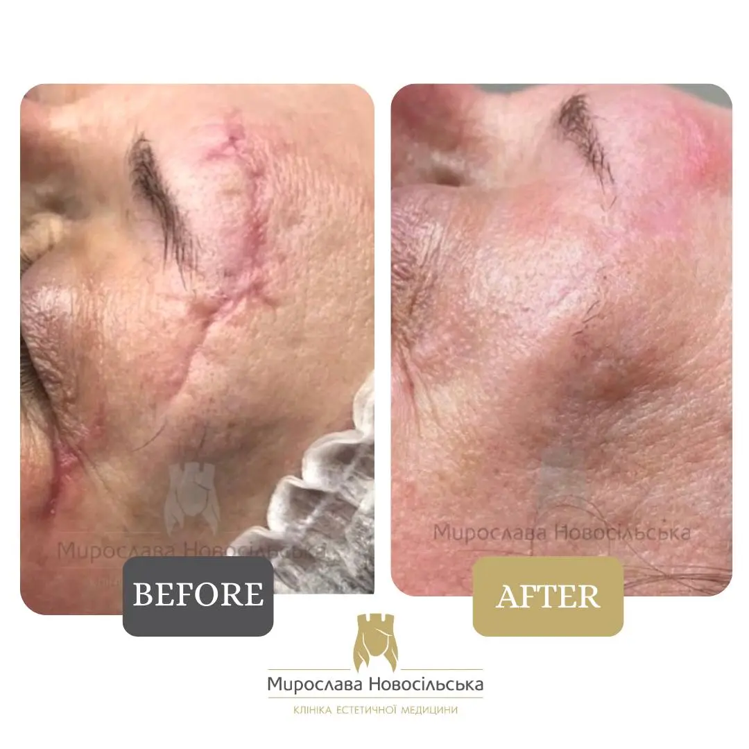 Laser scar removal, photo 6