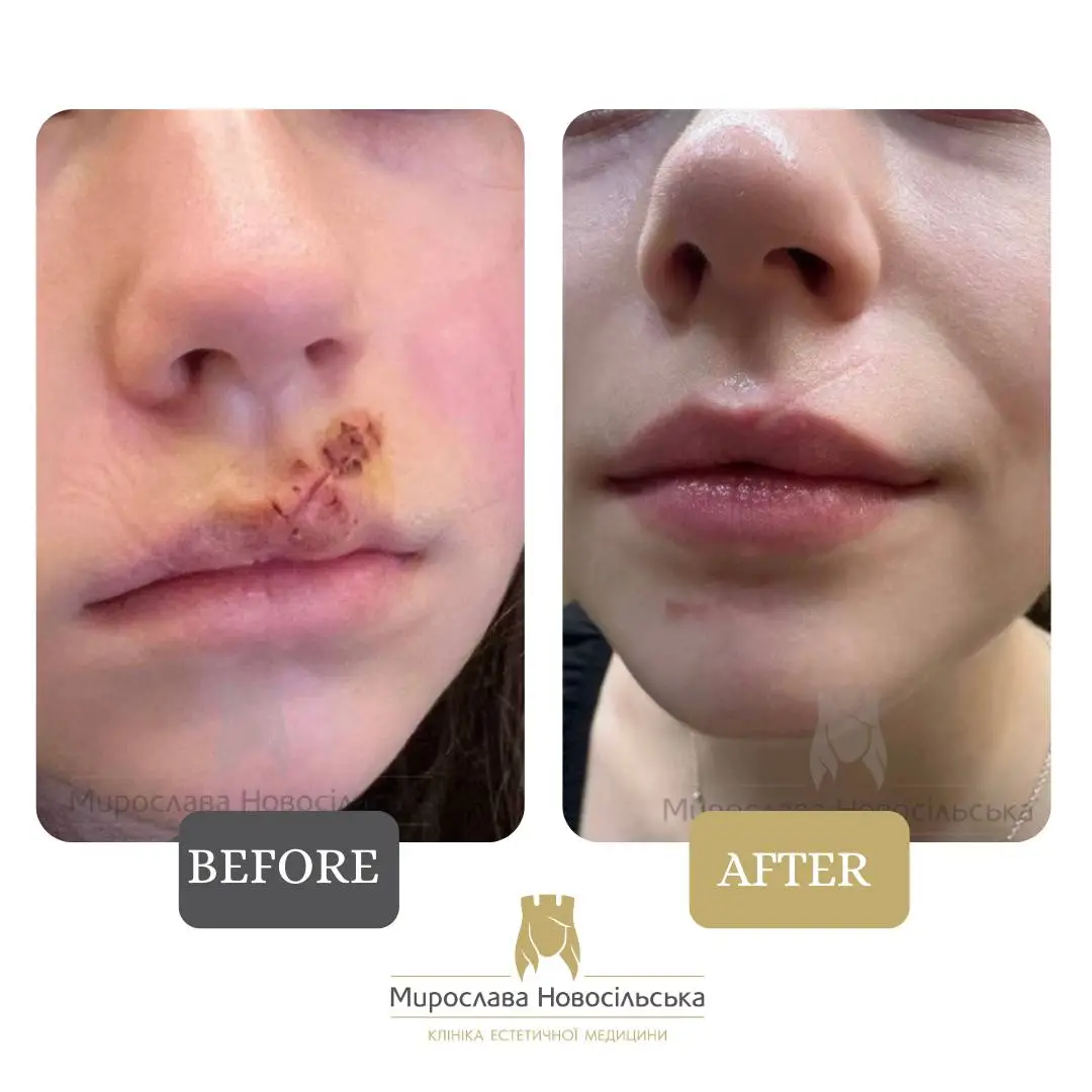 Laser scar removal
