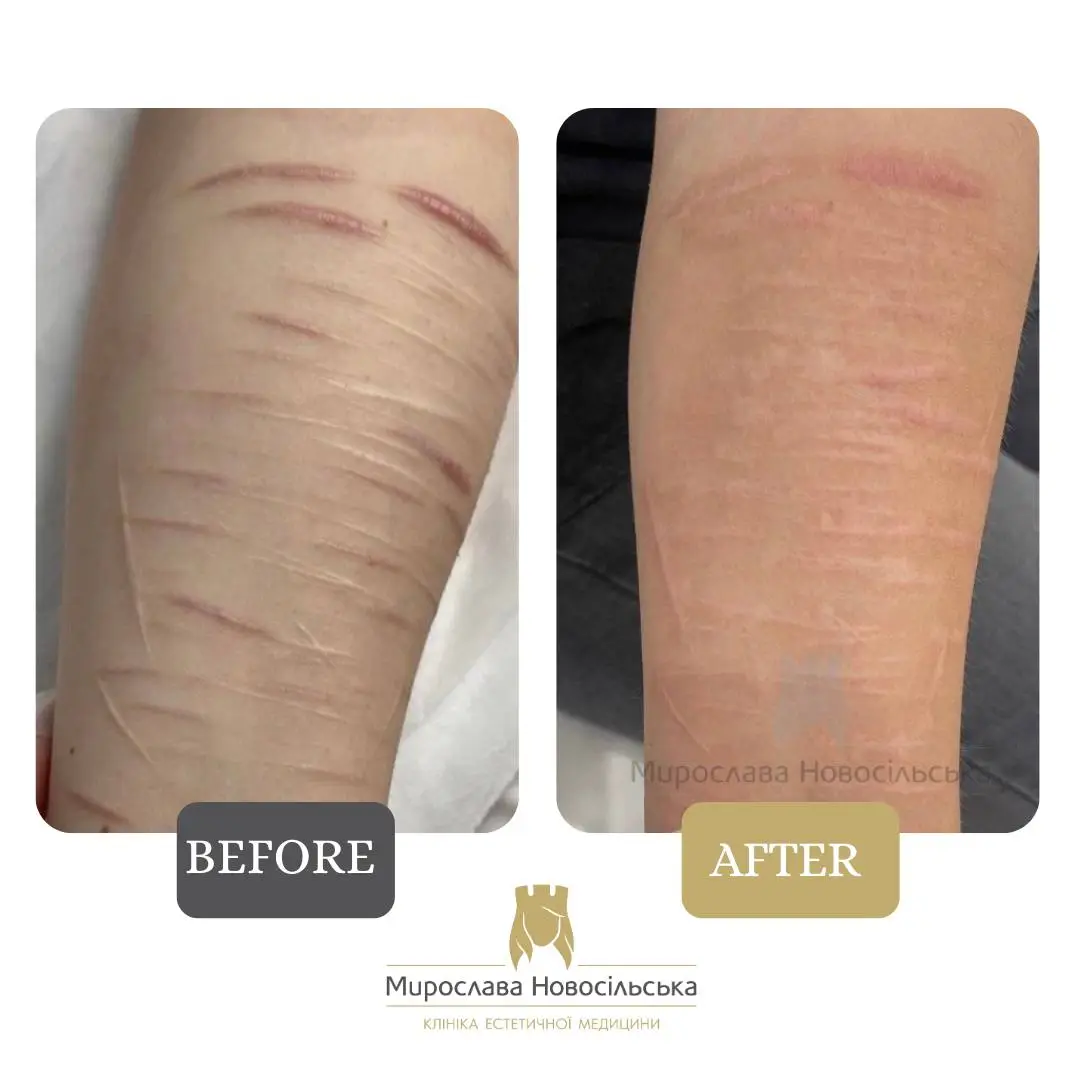 Laser scar removal, photo 4