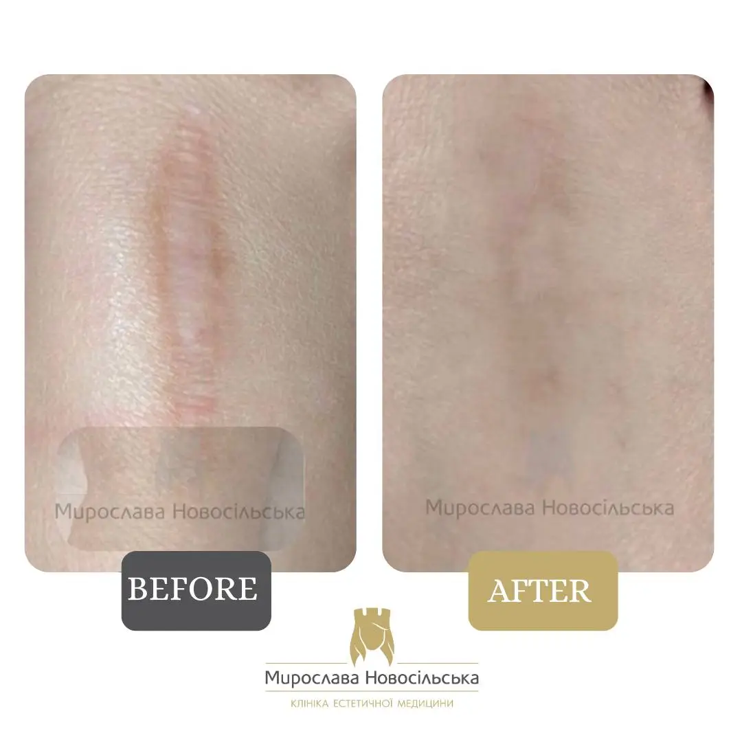 Laser scar removal
