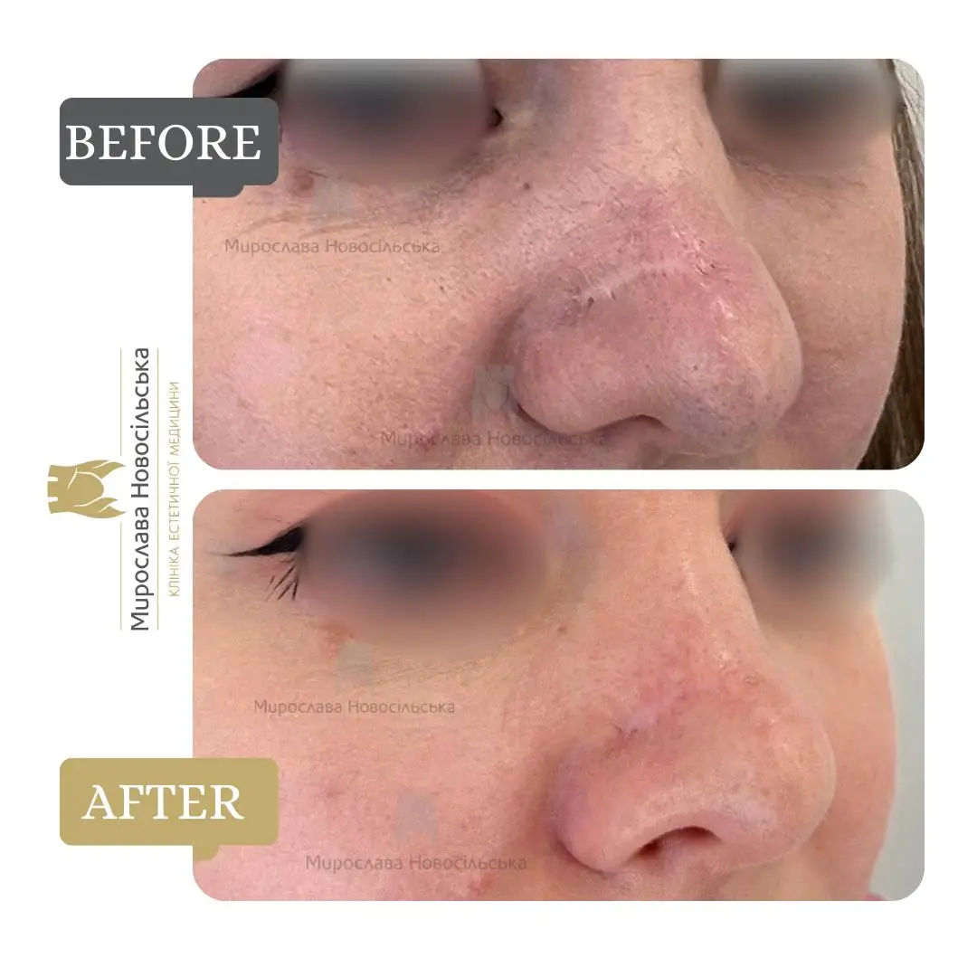 Laser scar removal, photo 7