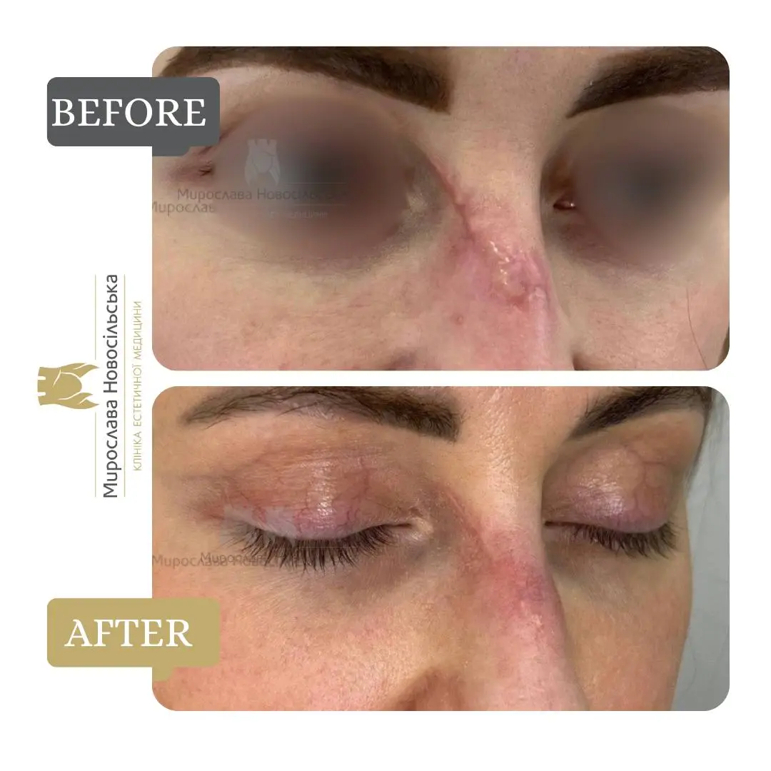 Laser scar removal, photo 8