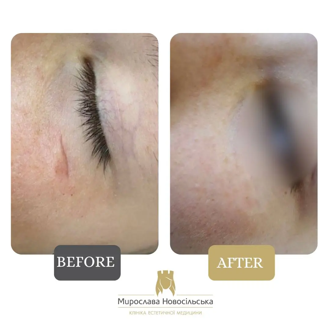 Laser scar removal, photo 9