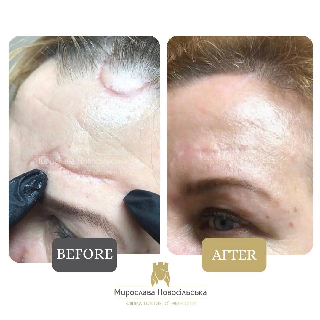 Laser scar removal, photo 10