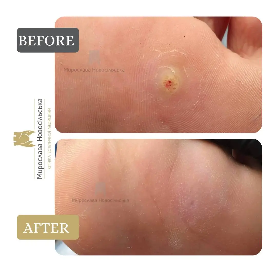 Laser wart removal