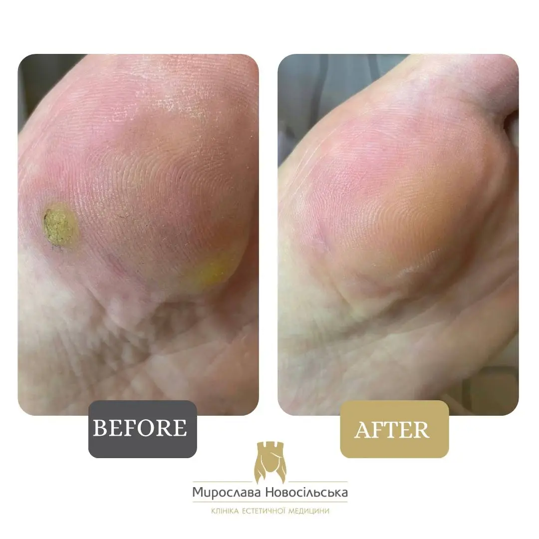 Laser wart removal