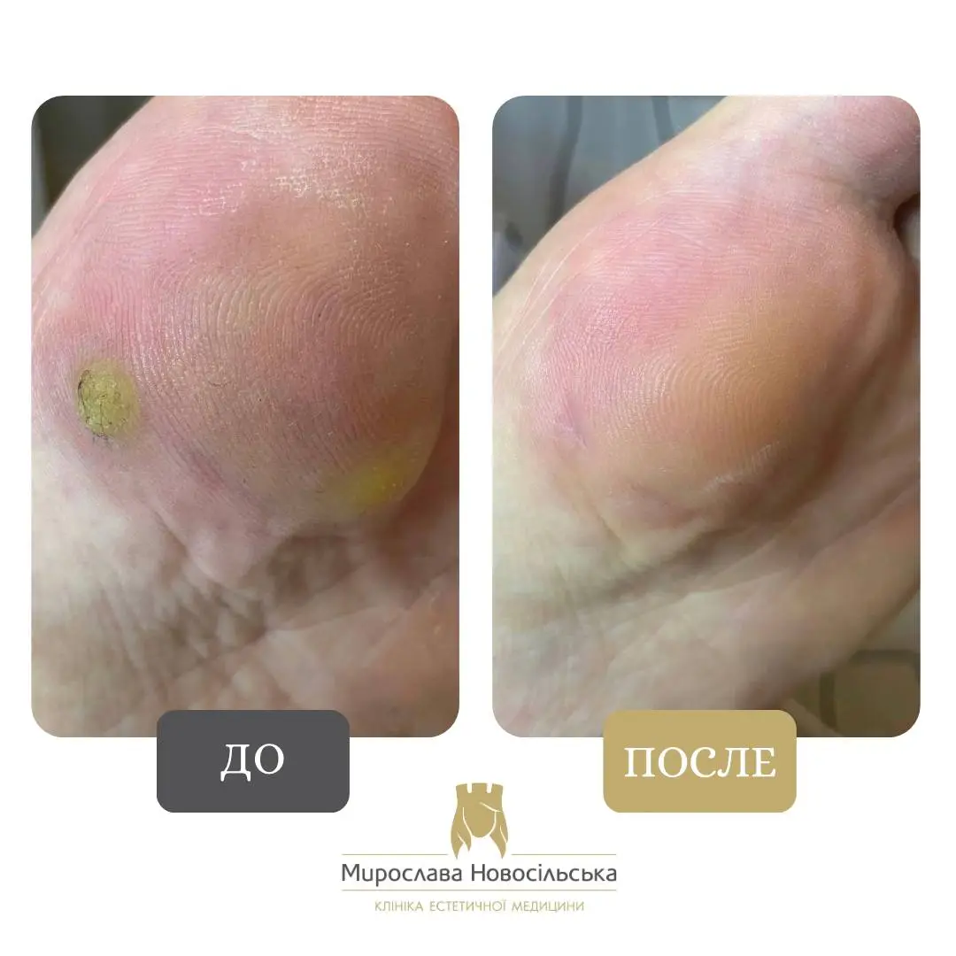 Лазерное удаление бородавок