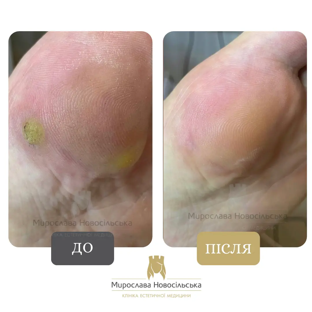 Лазерне видалення бородавок, фото 3