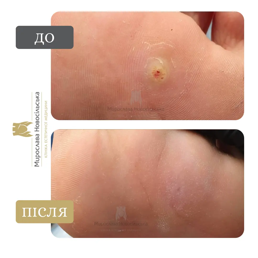 Лазерне видалення бородавок, фото 2