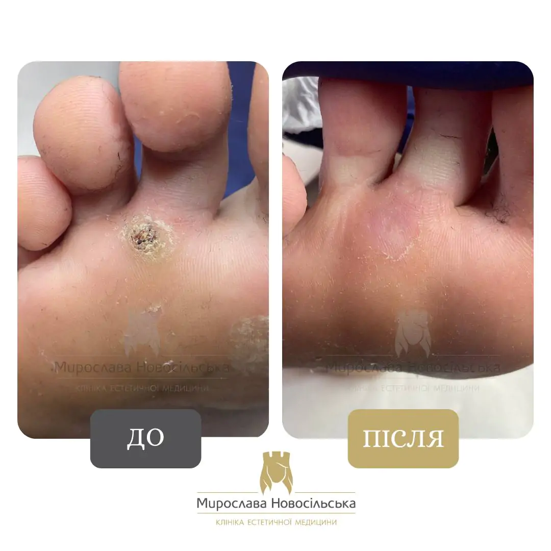 Лазерне видалення бородавок, фото 5