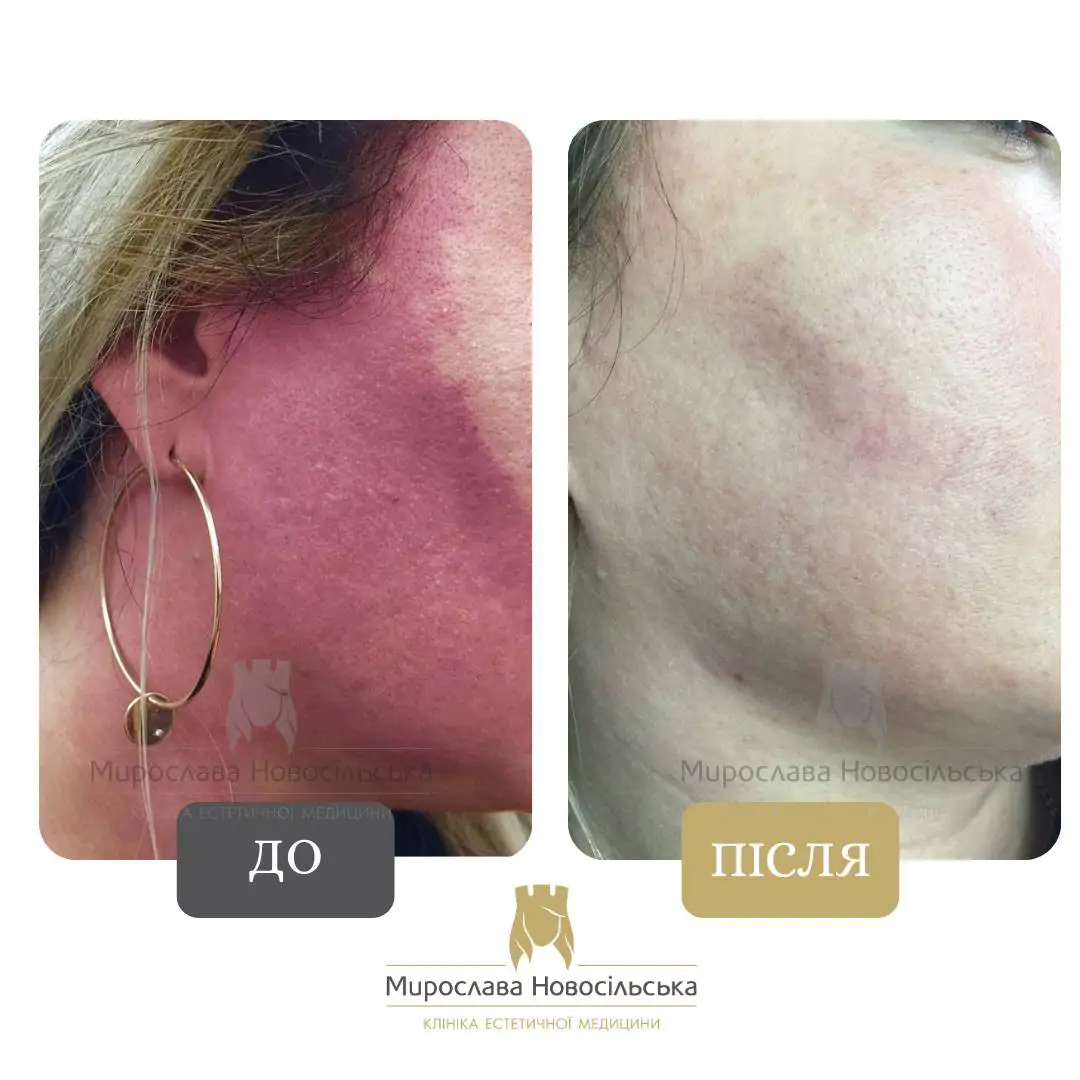 Лазерне видалення гемангіом, фото 2