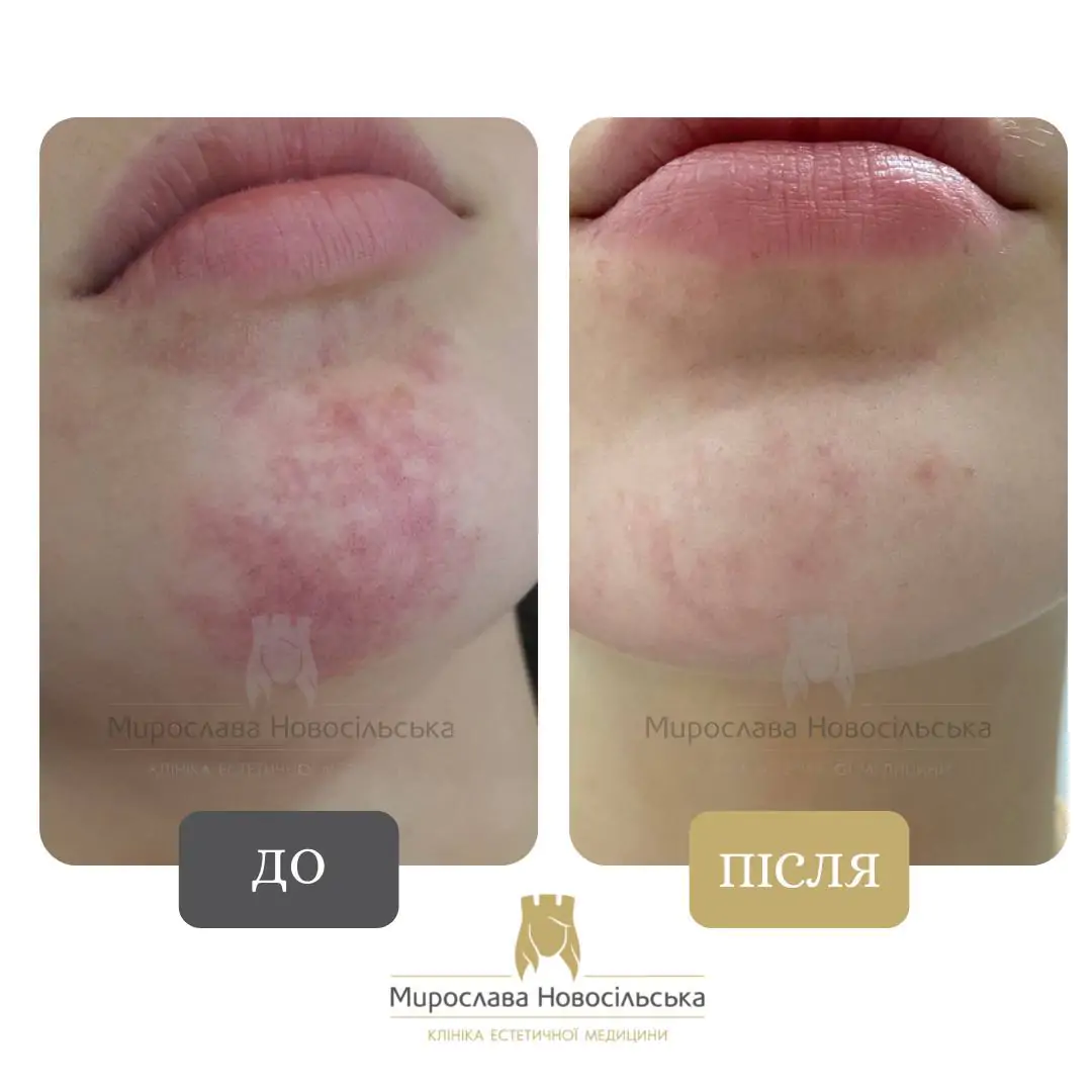 Лазерне видалення гемангіом, фото 3