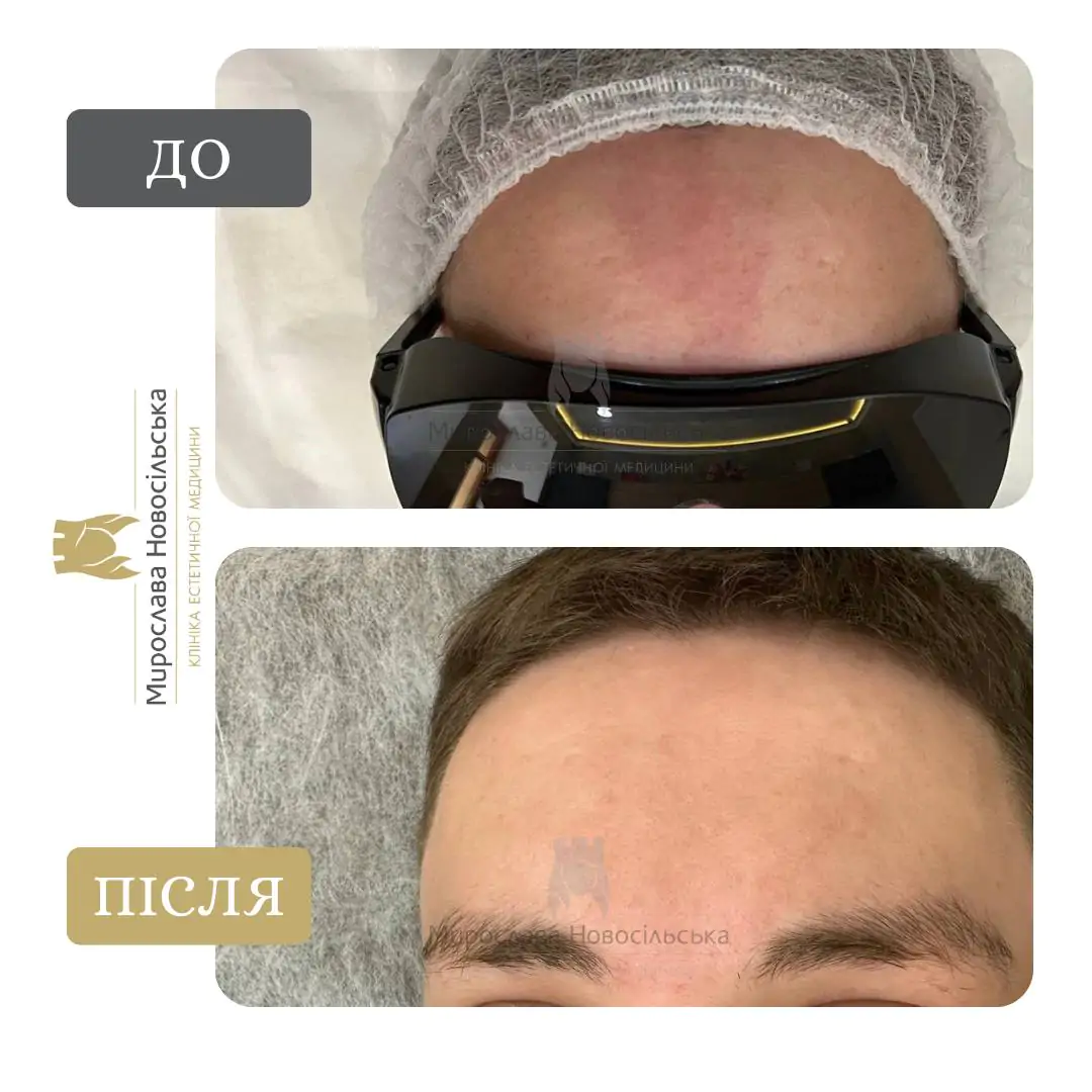 Лазерне видалення гемангіом, фото 4