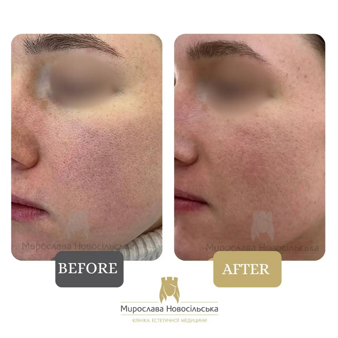 Facial peels