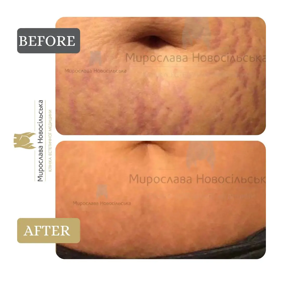 Laser resurfacing of stretch marks