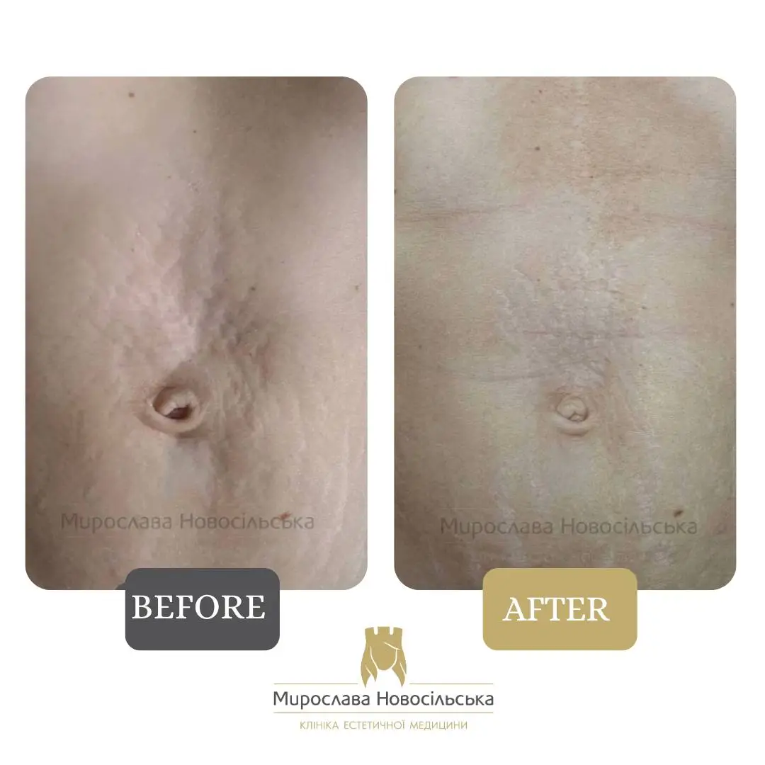 Laser resurfacing of stretch marks