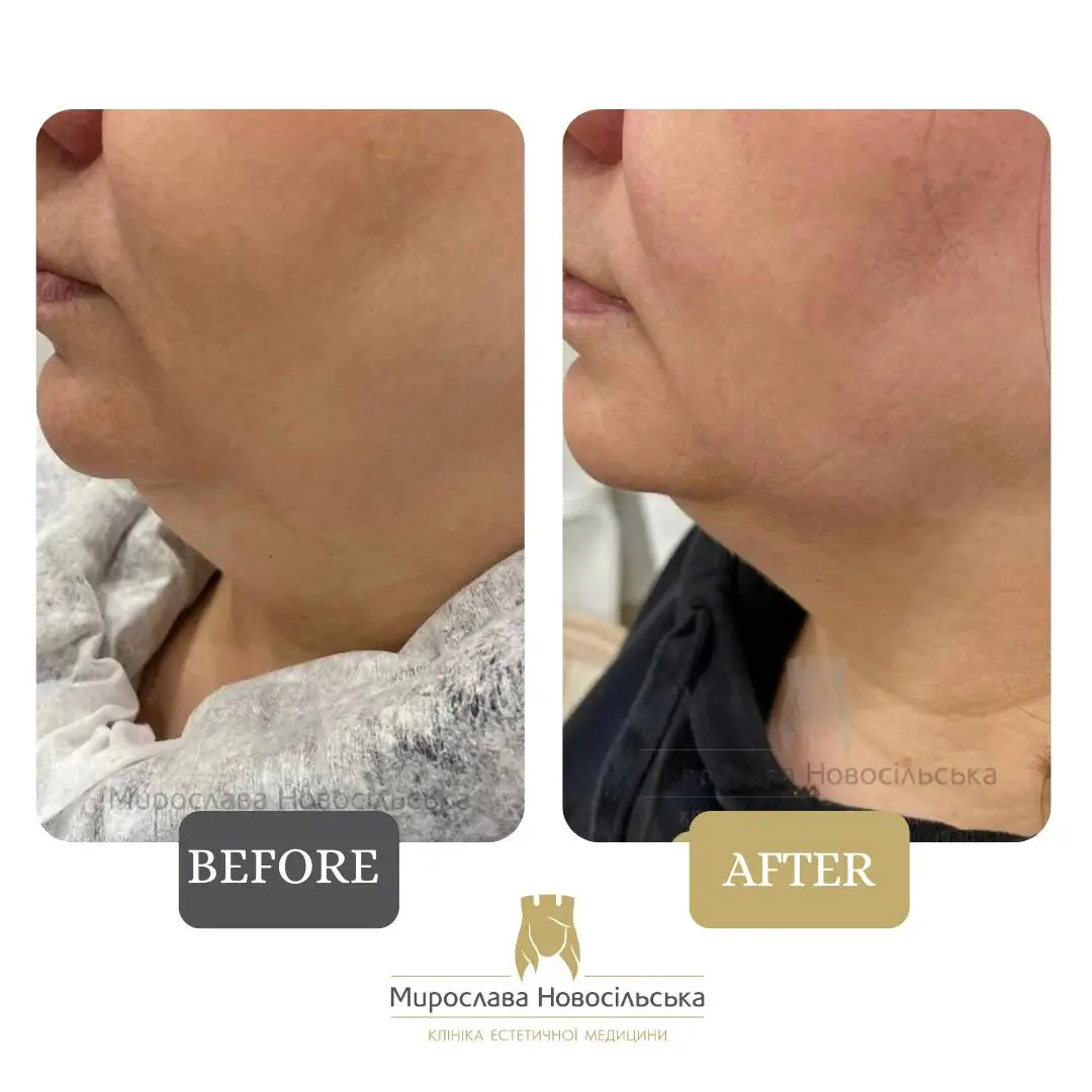 Smass ліфтинг, photo 6