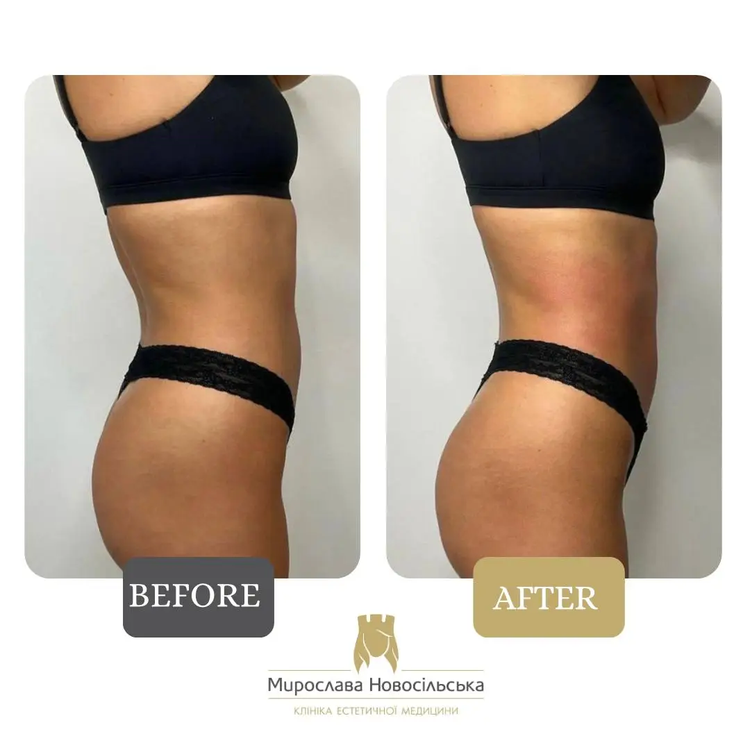 StratoSphere shape correction in Lviv, photo 5