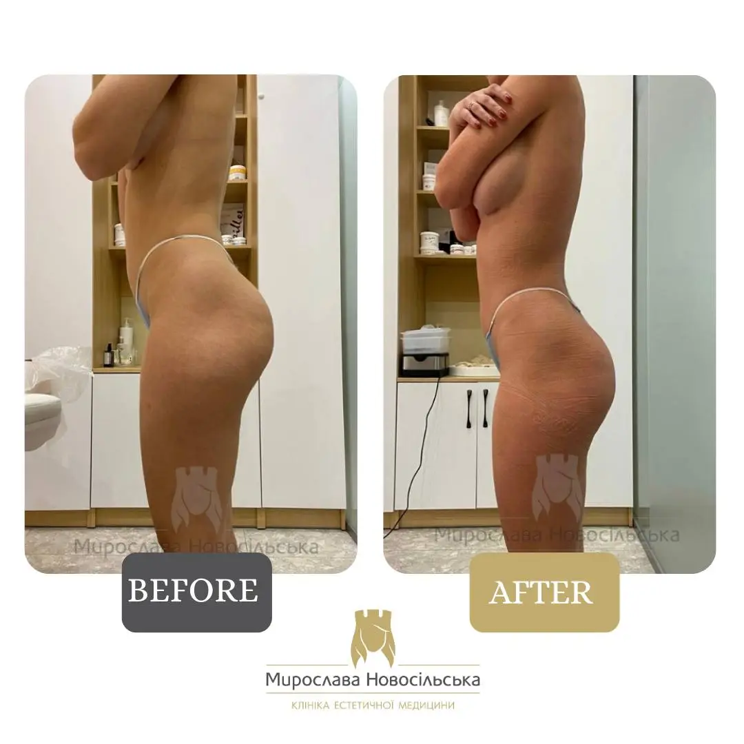 StratoSphere shape correction in Lviv, photo 7