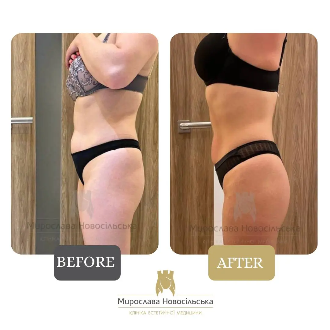 StratoSphere shape correction in Lviv, photo 6