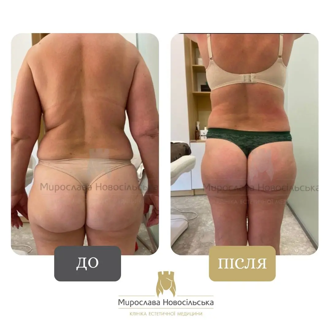 Апаратний Антицелюлітний Масаж Стратосфера у Львові, фото 2