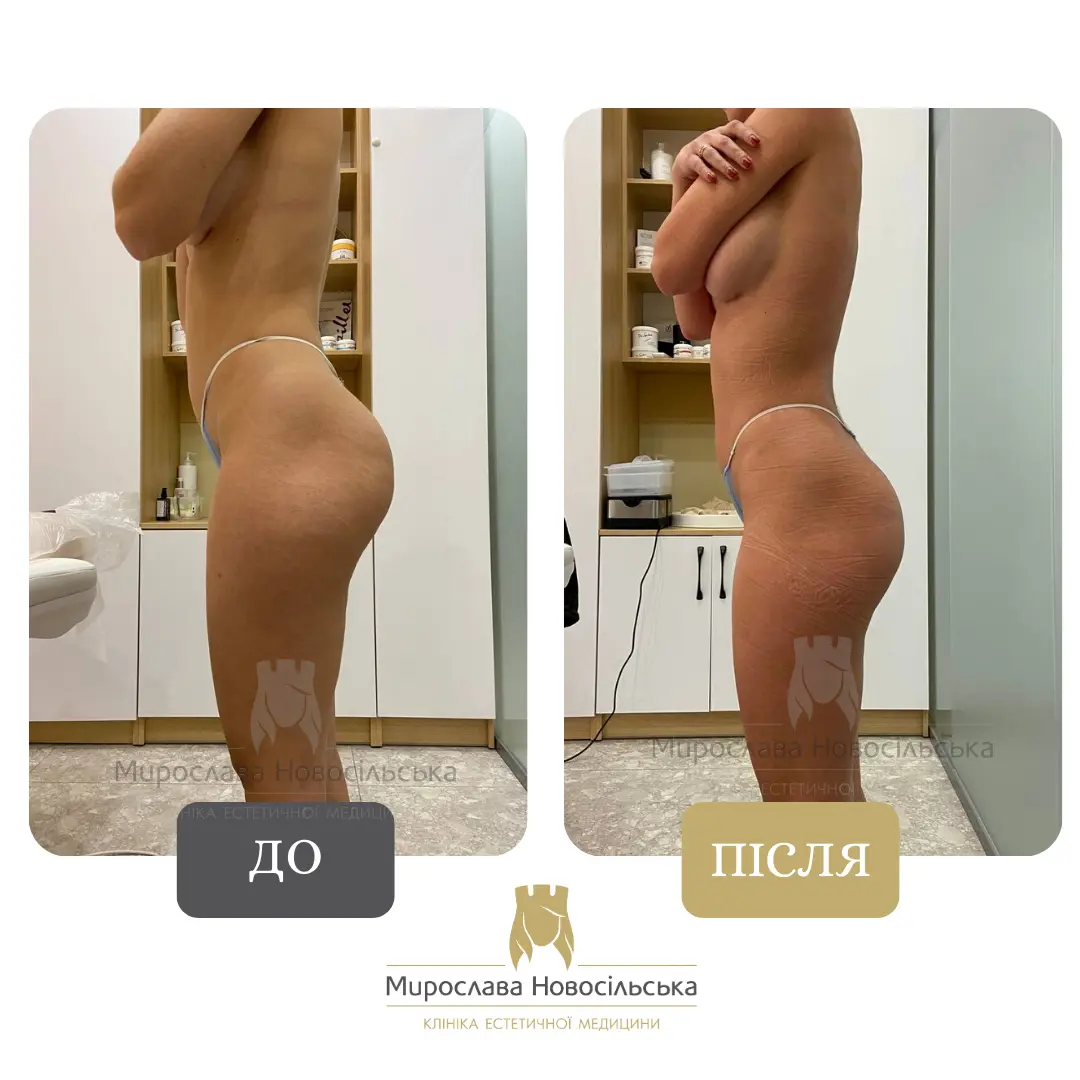 Апаратний Антицелюлітний Масаж Стратосфера у Львові, фото 7