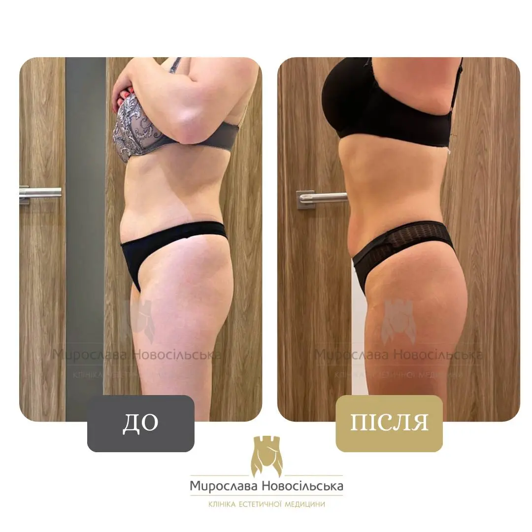 Апаратний Антицелюлітний Масаж Стратосфера у Львові, фото 6