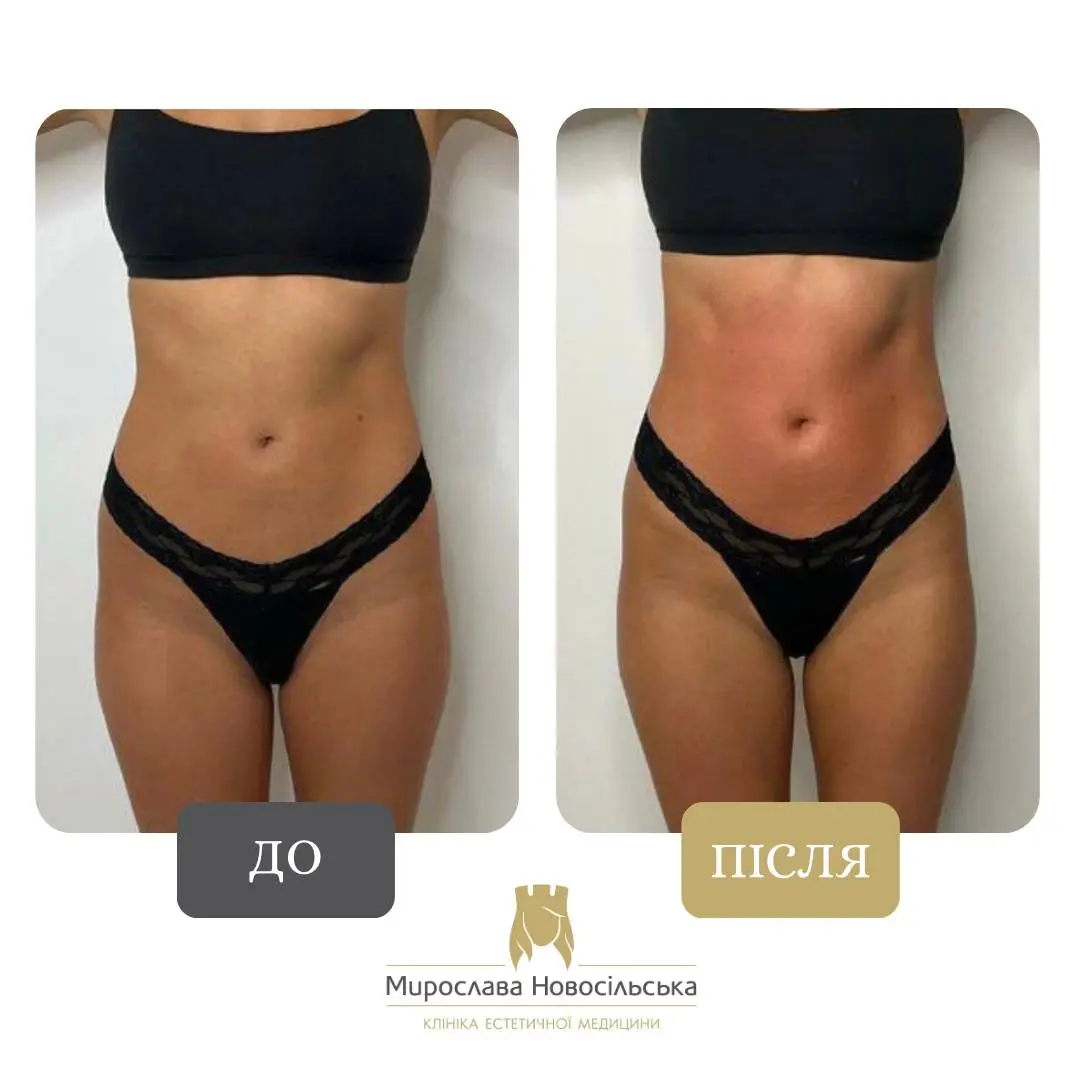 Апаратний Антицелюлітний Масаж Стратосфера у Львові, фото 4