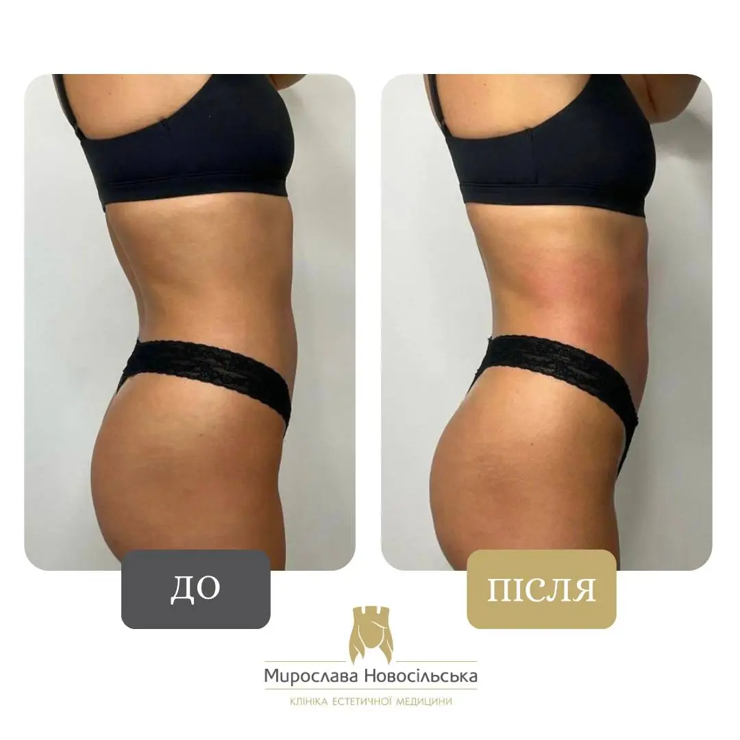 Апаратний Антицелюлітний Масаж Стратосфера у Львові, фото 5