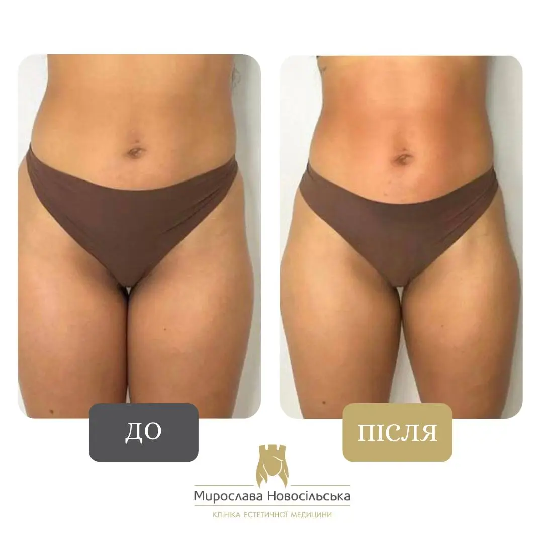 Апаратний Антицелюлітний Масаж Стратосфера у Львові, фото 3