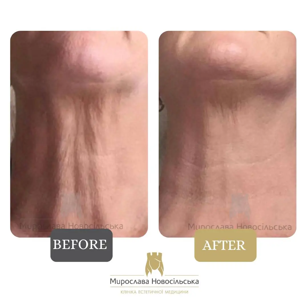 Thermolifting, photo 2