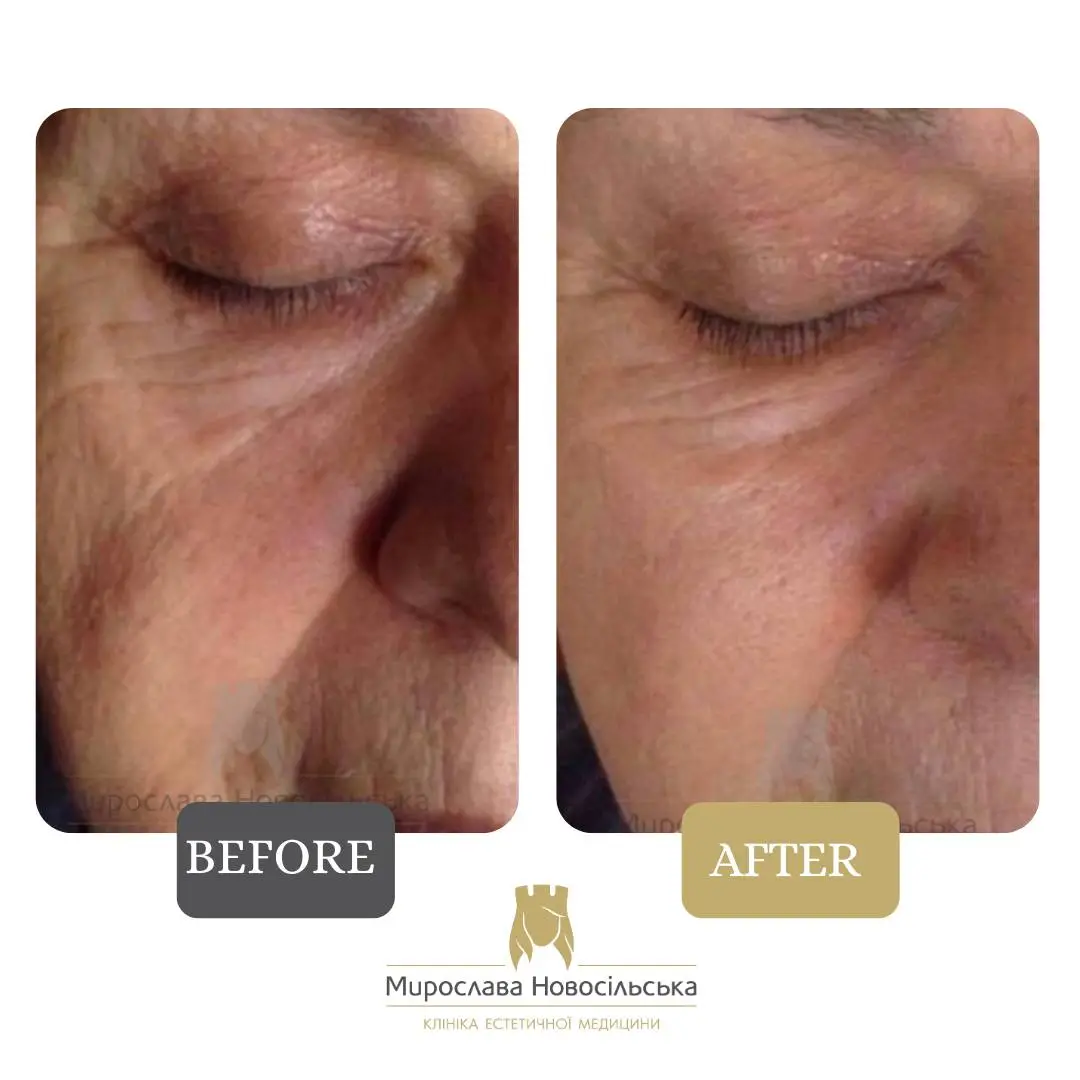 Thermolifting, photo 3