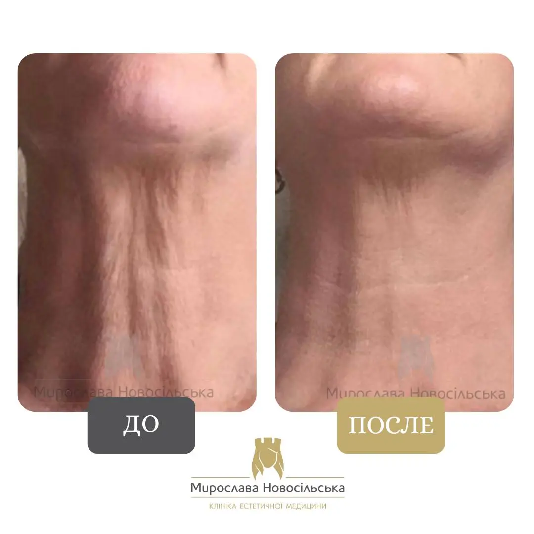 Термолифтинг, фото 2