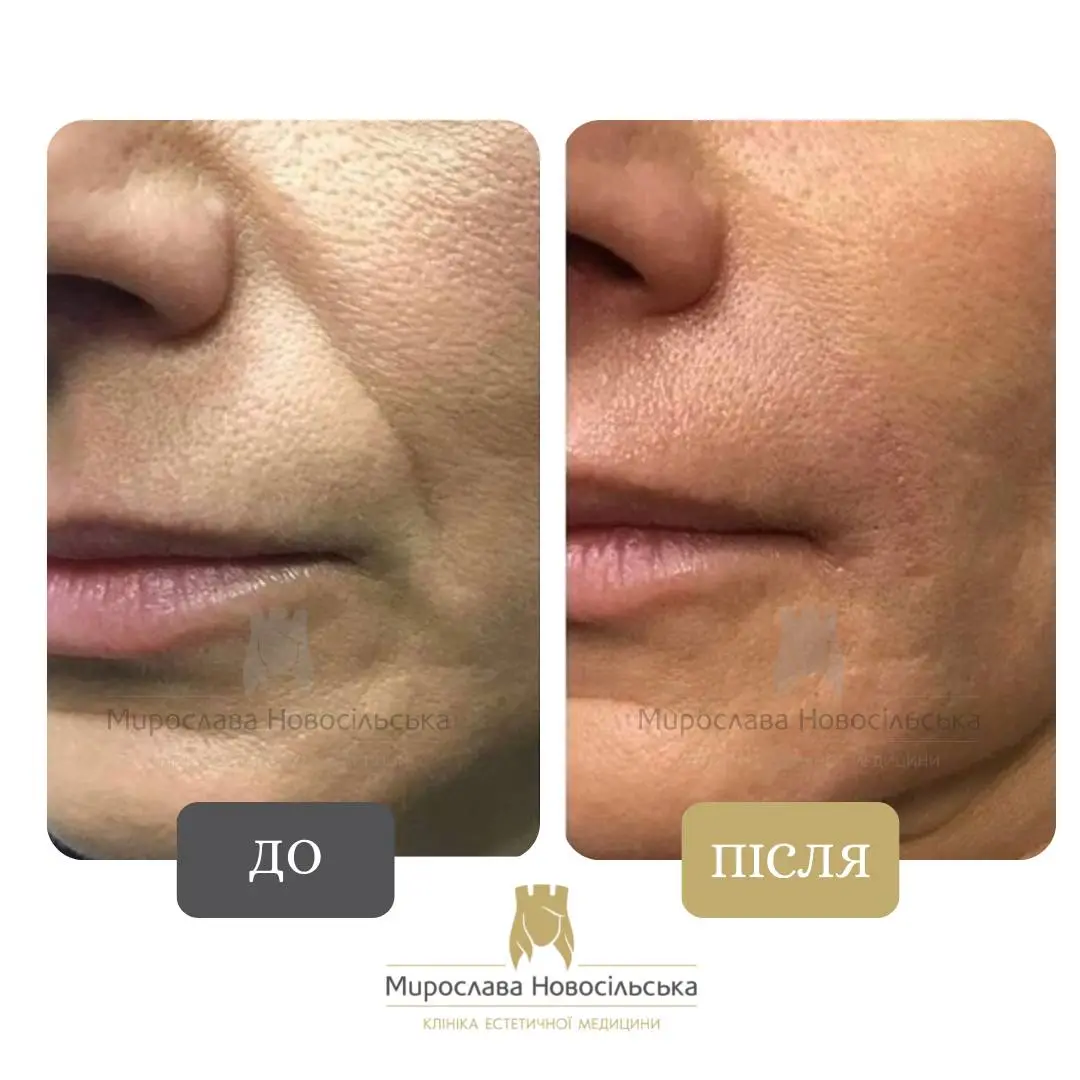 Термоліфтинг, фото 3