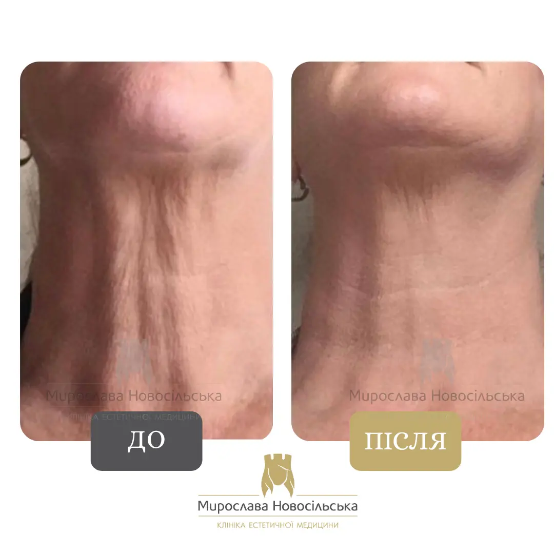 Термоліфтинг, фото 4