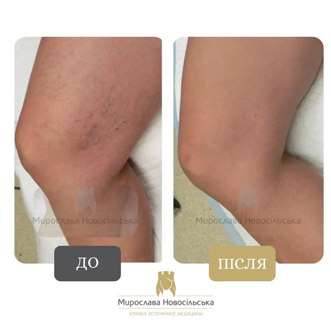 Лазерне видалення судин, фото 3