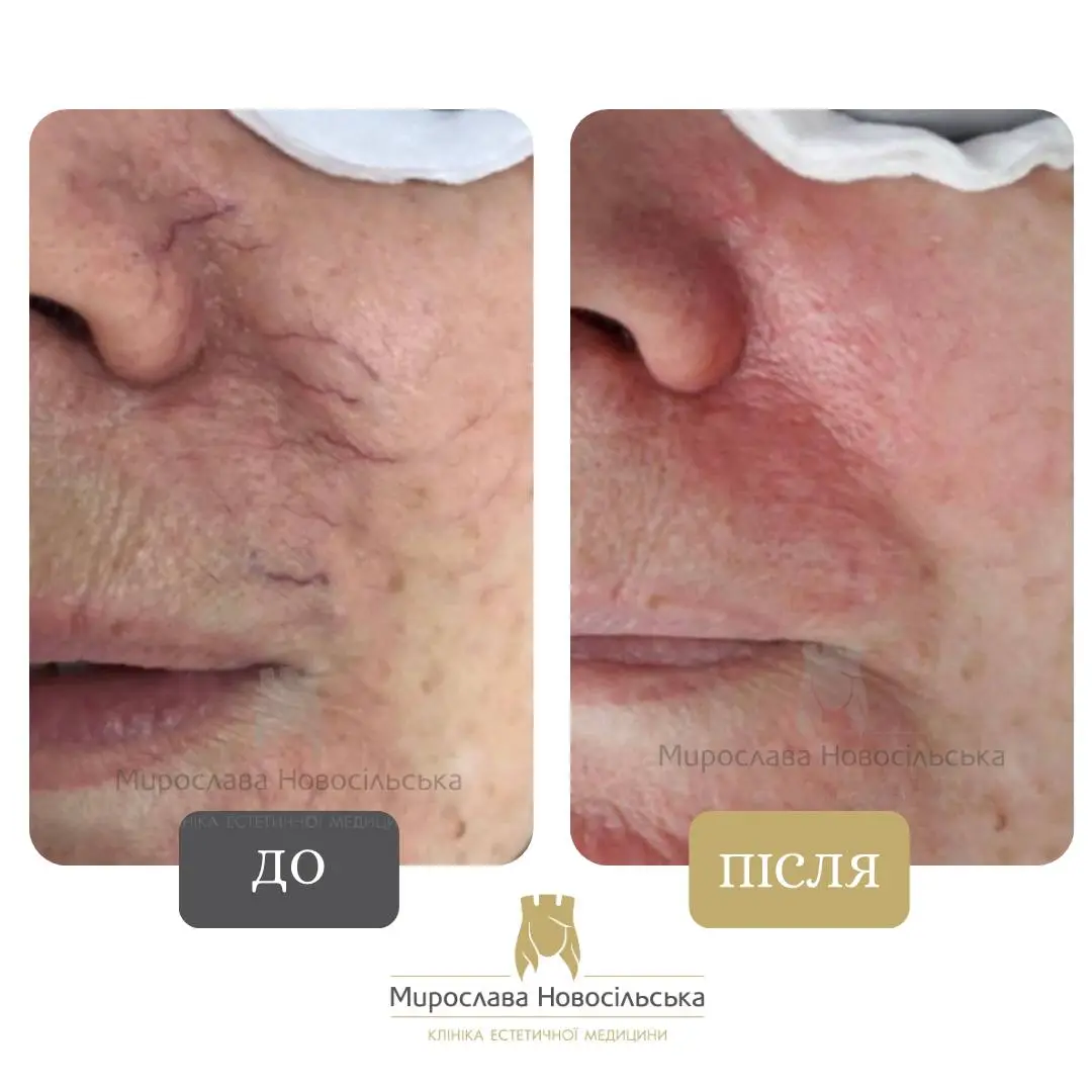 Лазерне видалення судин, фото 5