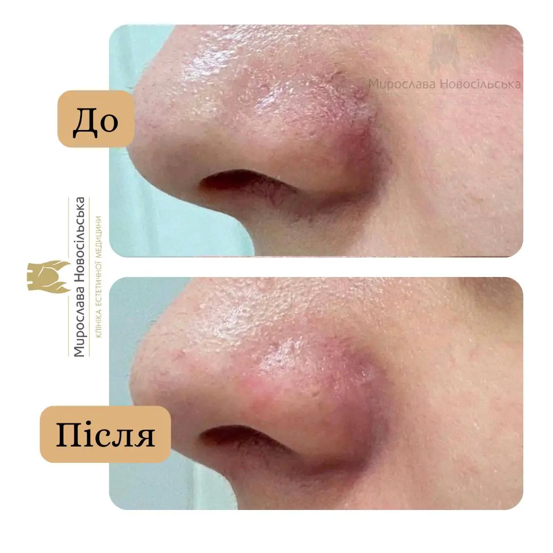 Лазерне видалення судин, фото 10