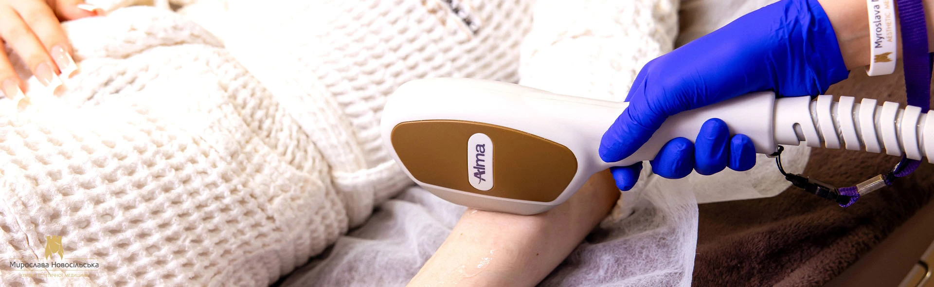 Laser epilation of hands
