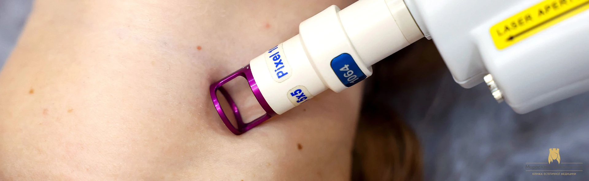 Laser removal of hemangiomas