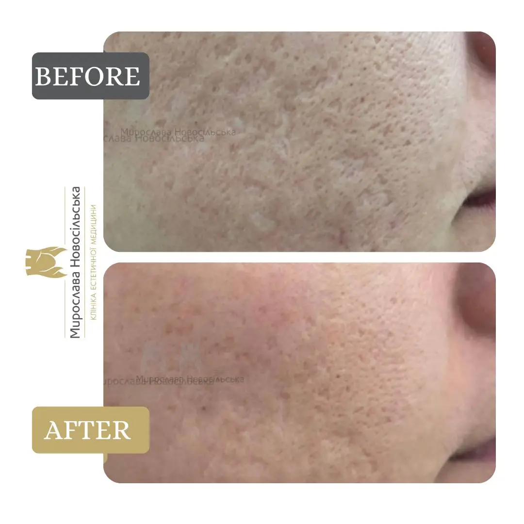 Laser resurfacing of scars and post acne, photo 10