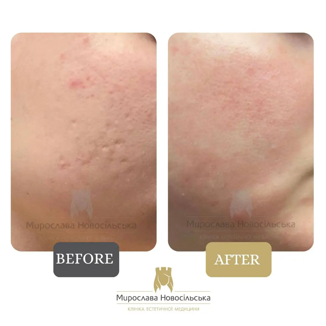 Laser resurfacing of scars and post acne, photo 11