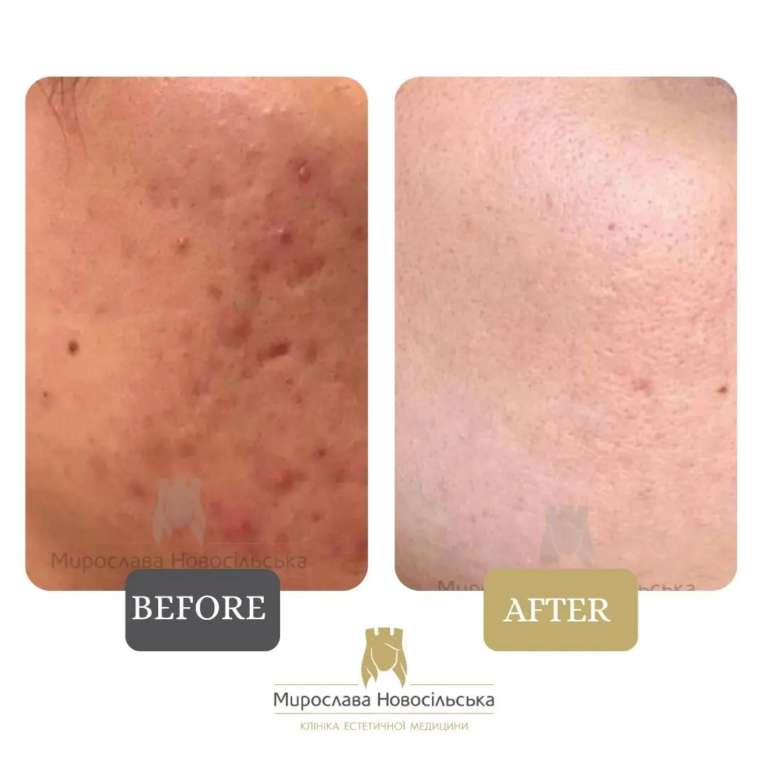 Laser resurfacing of scars and post acne, photo 9
