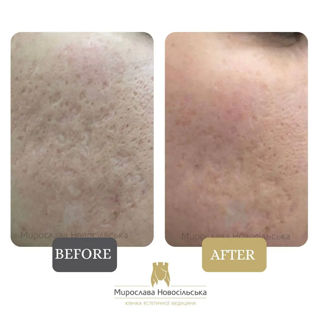 Laser resurfacing of scars and post acne, photo 8